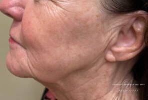 Jaw and neck after laser skin treatment, side profile view — Dr. Rudderman, Atlanta.