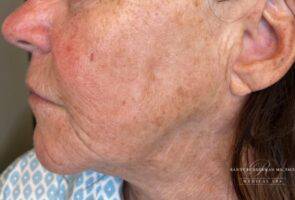 Cheek before laser skin treatment, three-quarter view — Dr. Rudderman, Atlanta.