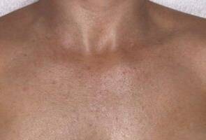 Chest after laser skin treatment, front view — Dr. Rudderman, Atlanta.