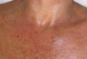 Chest before laser skin treatment, front view — Dr. Rudderman, Atlanta.