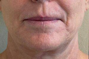 Mouth and chin after laser skin treatment, front view — Dr. Rudderman, Atlanta.