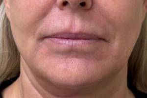 Mouth and chin before laser skin treatment, front view — Dr. Rudderman, Atlanta.