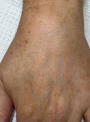 Hand after laser skin treatment, front view — Dr. Rudderman, Atlanta.