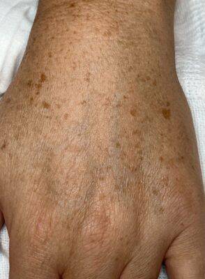 Hand before laser skin treatment, front view — Dr. Rudderman, Atlanta.