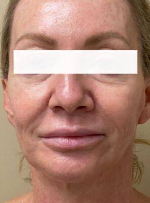 Face after laser skin treatment, front view — Dr. Rudderman, Atlanta.