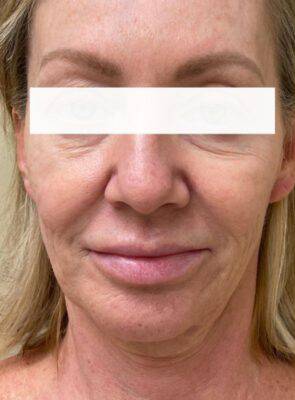 Face before laser skin treatment, front view — Dr. Rudderman, Atlanta.