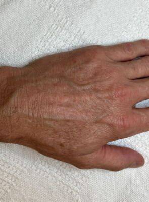 Hand after laser skin treatment, front view — Dr. Rudderman, Atlanta.
