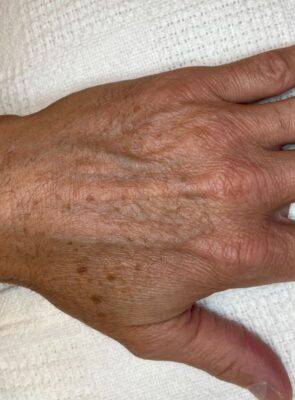 Hand before laser skin treatment, front view — Dr. Rudderman, Atlanta.