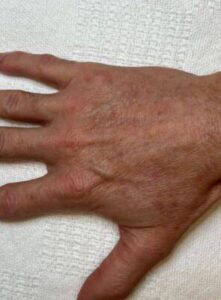 Hand after laser skin treatment, front view — Dr. Rudderman, Atlanta.