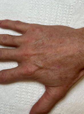 Hand after laser skin treatment, front view — Dr. Rudderman, Atlanta.