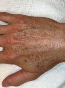 Hand before laser skin treatment, front view — Dr. Rudderman, Atlanta.