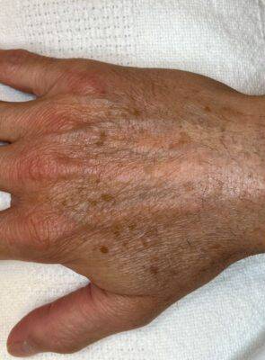 Hand before laser skin treatment, front view — Dr. Rudderman, Atlanta.