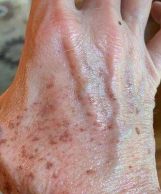 Hand before laser skin treatment, front view — Dr. Rudderman, Atlanta.