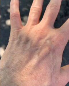 Hand after laser skin treatment, front view — Dr. Rudderman, Atlanta.