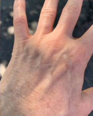 Hand after laser skin treatment, front view — Dr. Rudderman, Atlanta.