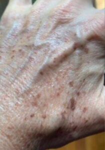 Hand before laser skin treatment, front view — Dr. Rudderman, Atlanta.