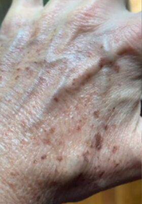 Hand before laser skin treatment, front view — Dr. Rudderman, Atlanta.