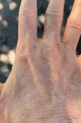 Hand after laser skin treatment, front view — Dr. Rudderman, Atlanta.