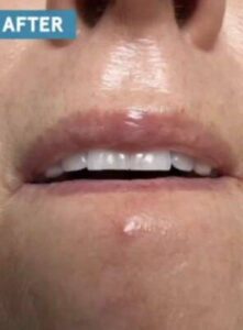 Skin around the mouth after laser skin treatment, front view — Dr. Rudderman, Atlanta.