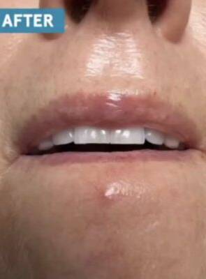 Skin around the mouth after laser skin treatment, front view — Dr. Rudderman, Atlanta.