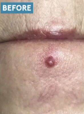 Skin around the mouth before laser skin treatment, front view — Dr. Rudderman, Atlanta.