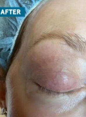 Brow and eyelid after laser skin treatment, front view — Dr. Rudderman, Atlanta.