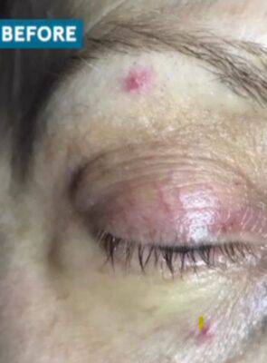 Brow and eyelid before laser skin treatment, front view — Dr. Rudderman, Atlanta.