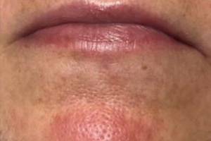 Chin and mouth before laser skin treatment, front view — Dr. Rudderman, Atlanta.