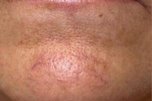 Chin and mouth after laser skin treatment, front view — Dr. Rudderman, Atlanta.