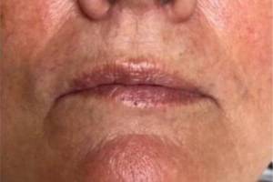 Mouth and cheek after laser skin treatment, front view — Dr. Rudderman, Atlanta.