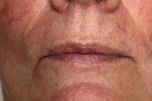 Mouth and cheek before laser skin treatment, front view — Dr. Rudderman, Atlanta.