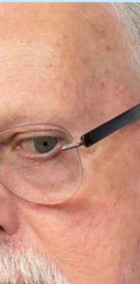 Temple after laser skin treatment, three-quarter view — Dr. Rudderman, Atlanta.