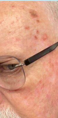 Temple before laser skin treatment, three-quarter view — Dr. Rudderman, Atlanta.