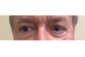 Skin before Subnovii plasma treatment, front view — Dr. Rudderman, Atlanta.