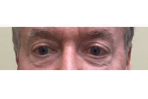 Skin after Subnovii plasma treatment, front view — Dr. Rudderman, Atlanta.