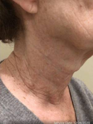 Subnovii plasma treatment patient photo, three-quarter view of the treated skin — Dr. Rudderman, Atlanta.