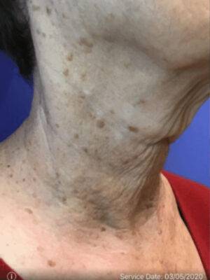 Subnovii plasma treatment patient photo, three-quarter view of the treated skin — Dr. Rudderman, Atlanta.