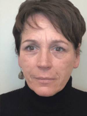 Skin before Subnovii plasma treatment, front view — Dr. Rudderman, Atlanta.