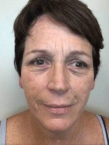 Skin after Subnovii plasma treatment, front view — Dr. Rudderman, Atlanta.