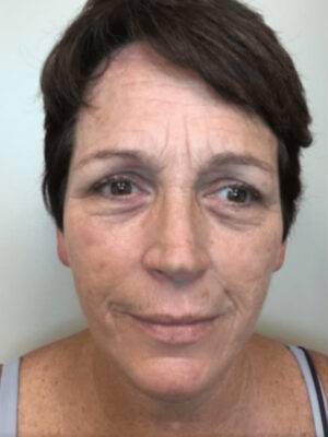 Skin after Subnovii plasma treatment, front view — Dr. Rudderman, Atlanta.