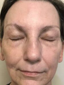 Subnovii plasma treatment patient photo, front view of the treated skin — Dr. Rudderman, Atlanta.