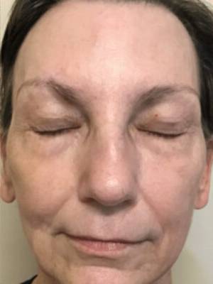 Subnovii plasma treatment patient photo, front view of the treated skin — Dr. Rudderman, Atlanta.