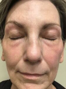 Subnovii plasma treatment patient photo, front view of the treated skin — Dr. Rudderman, Atlanta.