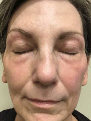 Subnovii plasma treatment patient photo, front view of the treated skin — Dr. Rudderman, Atlanta.