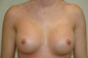 Breasts after breast augmentation, front view, patient 3 — Dr. Rudderman, Atlanta.