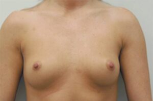 Breasts before breast augmentation, front view, patient 3 — Dr. Rudderman, Atlanta.