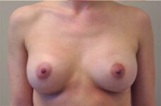 Breasts after breast augmentation, front view, patient 10 — Dr. Rudderman, Atlanta.
