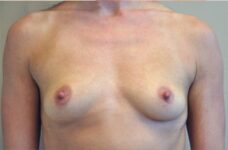 Breasts before breast augmentation, front view, patient 10 — Dr. Rudderman, Atlanta.