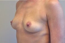 Breasts before breast augmentation, three-quarter view, patient 10 — Dr. Rudderman, Atlanta.
