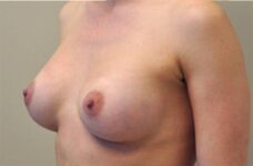 Breasts after breast augmentation, three-quarter view, patient 10 — Dr. Rudderman, Atlanta.